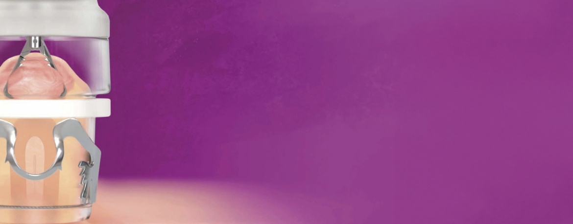 Endoscopic Full Thickness Resection with FTRD System